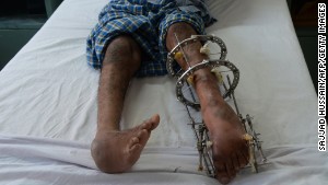 140305152904-polio-patient-feet-india-story-body.jpg