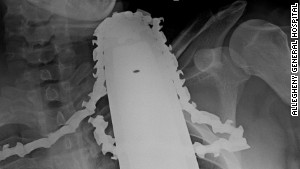 140401211552-chainsaw-xray-story-body.jpg